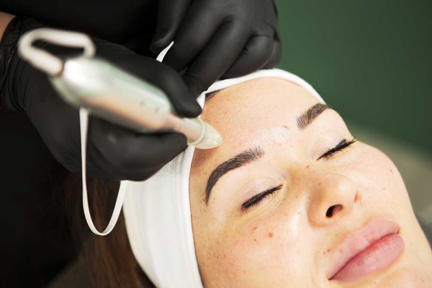 SkinNeedling SkinNeedling